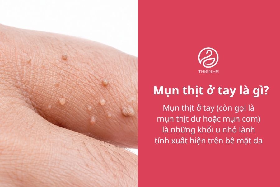 Mụn thịt ở tay: Nguyên nhân, cách nhận biết và phương pháp điều trị hiệu quả 1 Mụn thịt ở tay là gì?