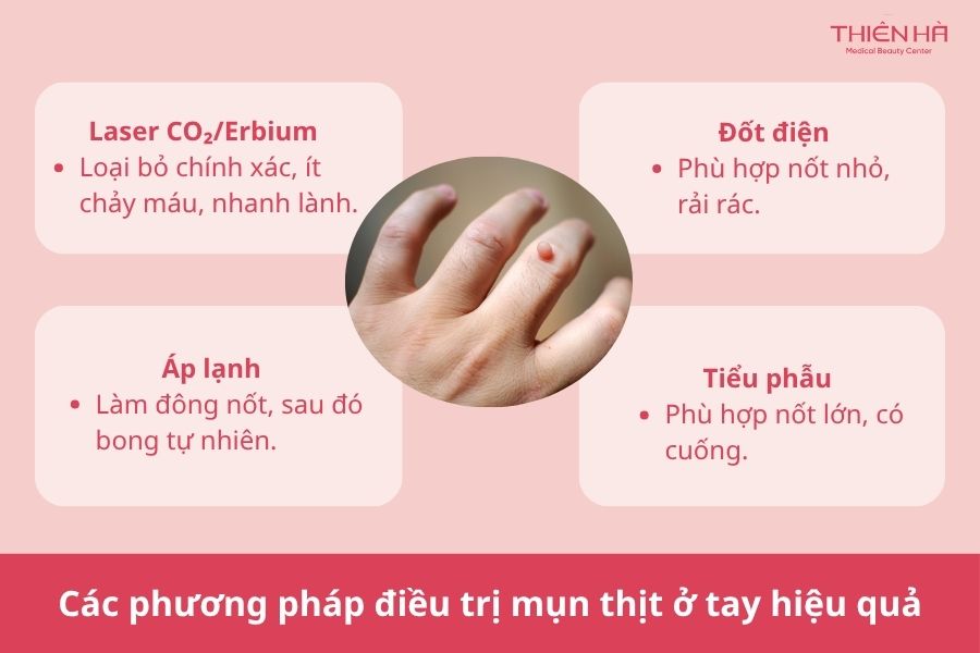 Mụn thịt ở tay: Nguyên nhân, cách nhận biết và phương pháp điều trị hiệu quả 4 Các phương pháp điều trị mụn thịt ở tay hiệu quả nhất hiện nay