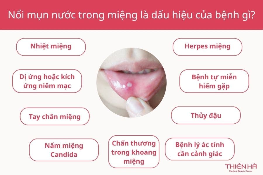 Nổi mụn nước trong miệng: Nguyên nhân, dấu hiệu và cách xử lý 2 Nổi mụn nước trong miệng là dấu hiệu của bệnh gì?
