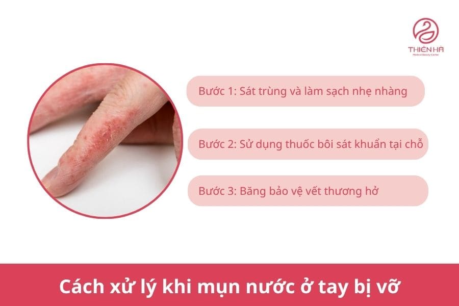 Cách xử lý khi mụn nước ở tay bị vỡ