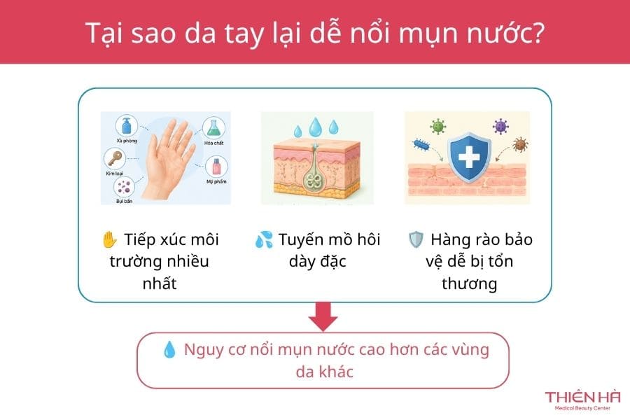 Tại sao da tay lại dễ nổi mụn nước?