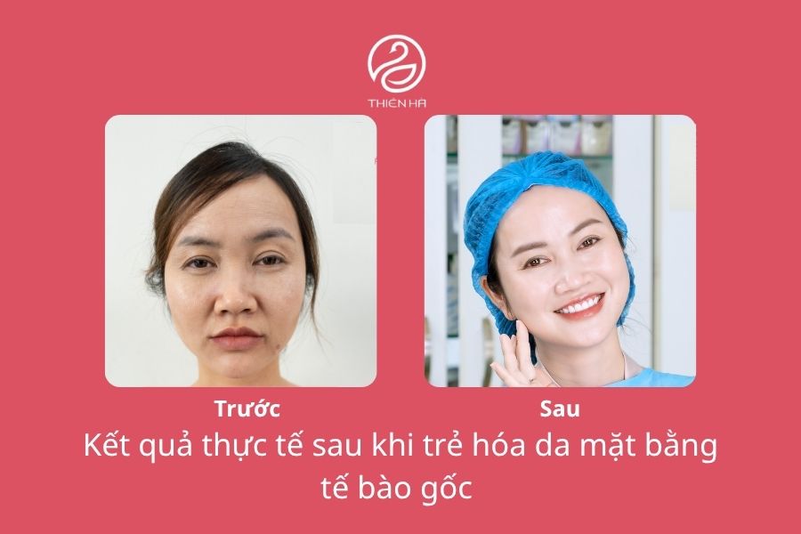 Trẻ hóa da mặt bằng tế bào gốc: Giải đáp từ Bác sĩ Da liễu đầu ngành 6 Hình ảnh hiệu quả thực tế trẻ hóa da mặt bằng tế bào gốc