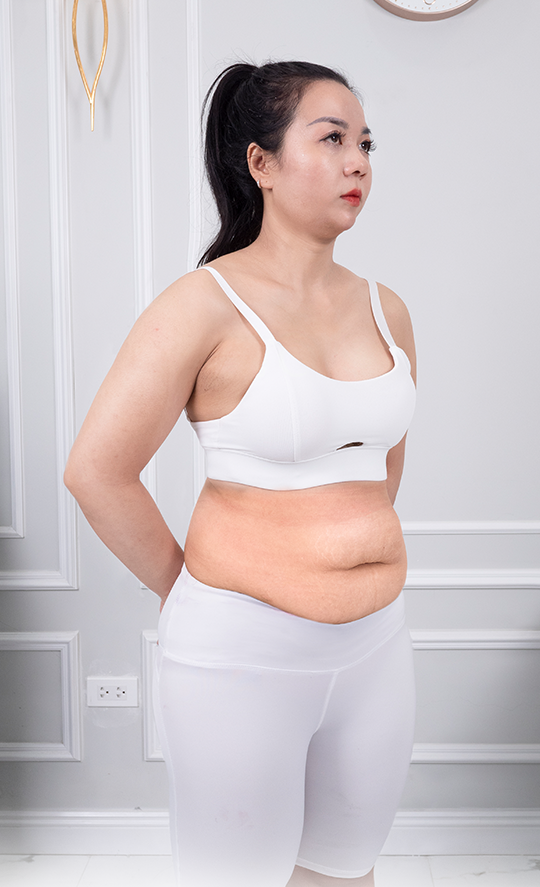 Giảm mỡ – 3 liệu trình – Gọn gàng quyến rũ - trước