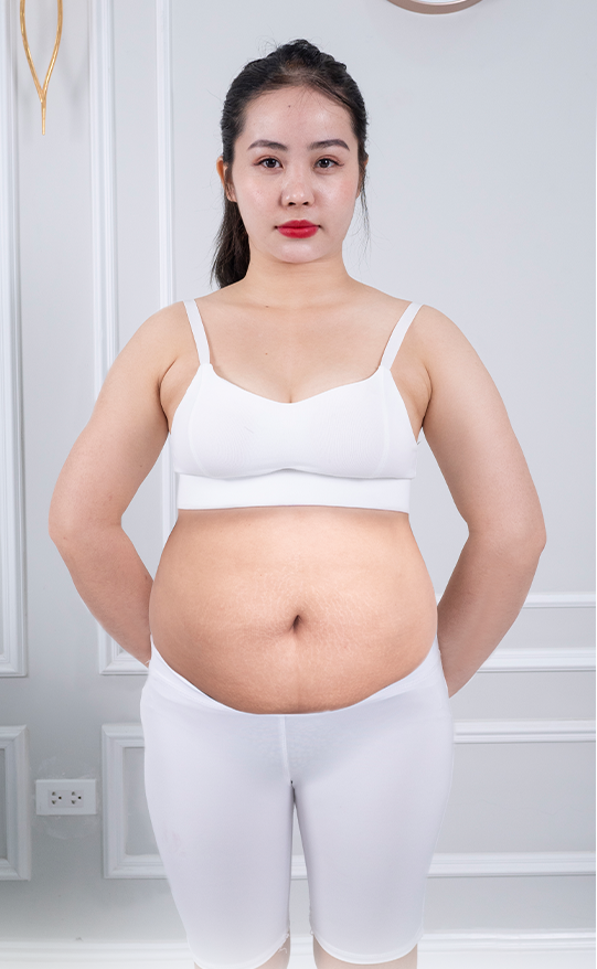 Giảm mỡ – 2 liệu trình – Lấy lại vóc dáng sau sinh - trước