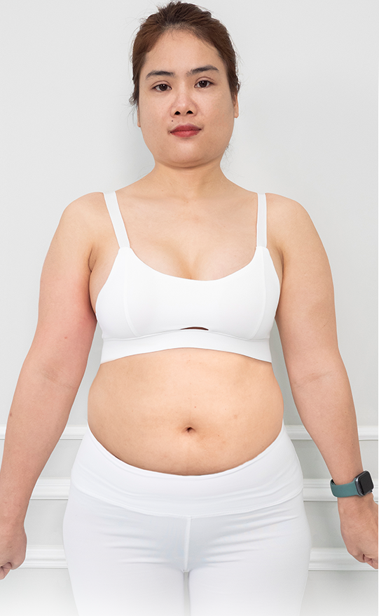 Giảm mỡ – 3 liệu trình – Giảm mỡ nhanh chóng, người không mệt mỏi - trước