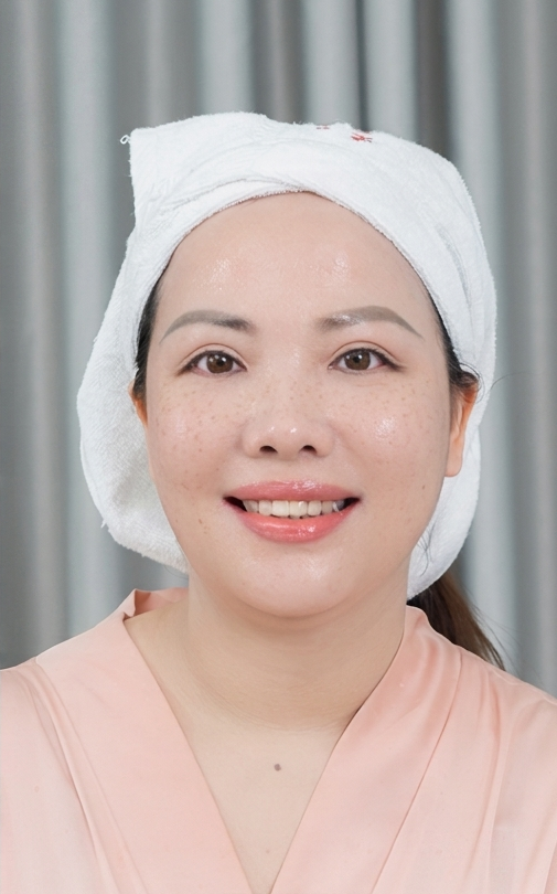 Trị Nám – 3 liệu trình – Nám hỗn hợp đã giảm rõ rệt - sau