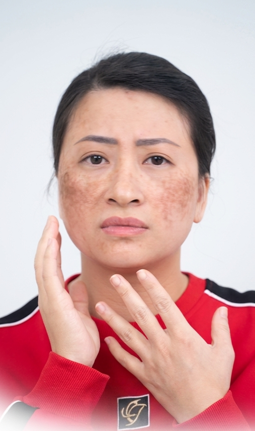 Trị Nám – 3 liệu trình – Da khỏe đều màu - trước