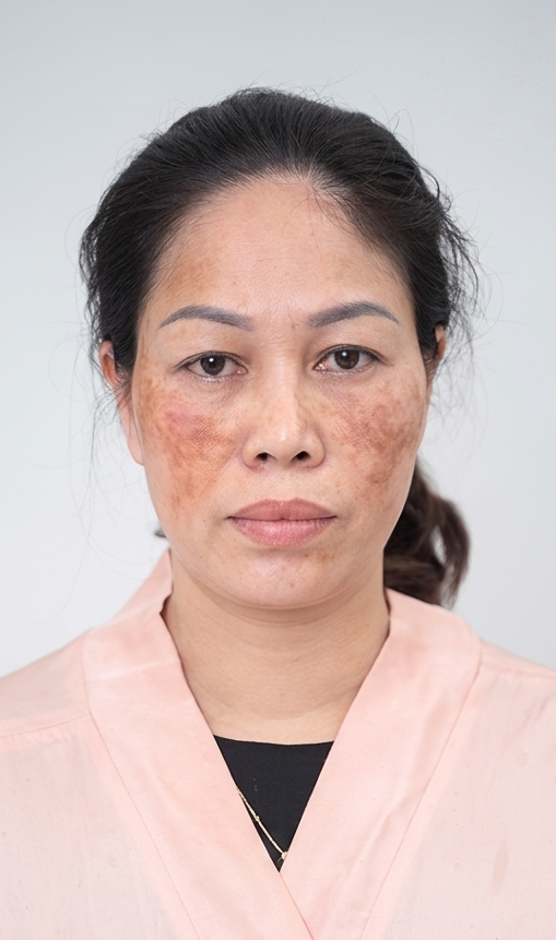 Trị Nám – 2 liệu trình – Da đều màu căng bóng - trước