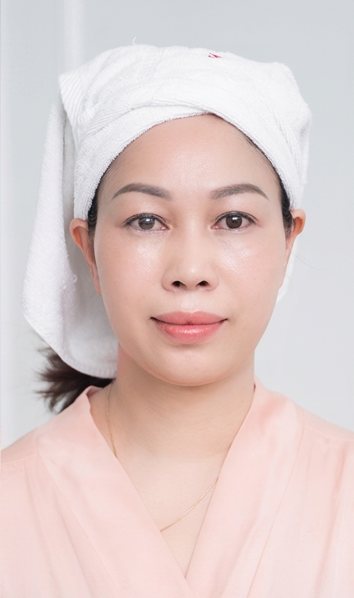 Trị Nám – 2 liệu trình – Da đều màu căng bóng - sau
