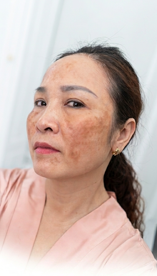 Trị Nám – 2 liệu trình – Da đều màu sáng mịn - trước