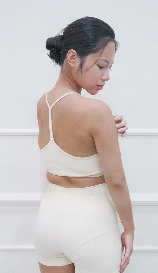 Tắm trắng body – 14 buổi – Tắm trắng cho da ngăm bẩm sinh - trước