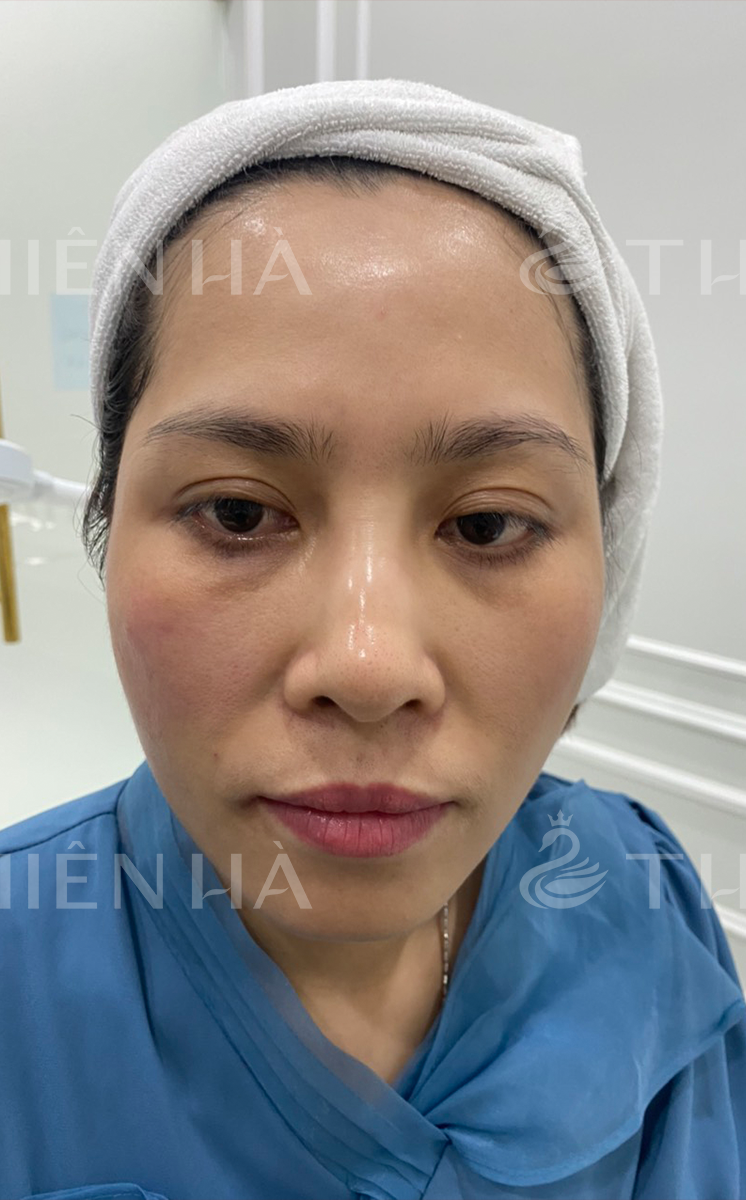 Trẻ hóa – 4 buổi – Cải thiện rõ rệt phần thái dương - trước