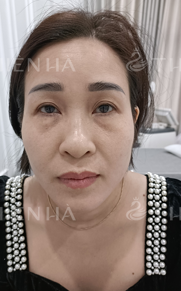 Trẻ hóa – 6 buổi – Làm đầy thái dương, xóa thâm vùng mắt - trước