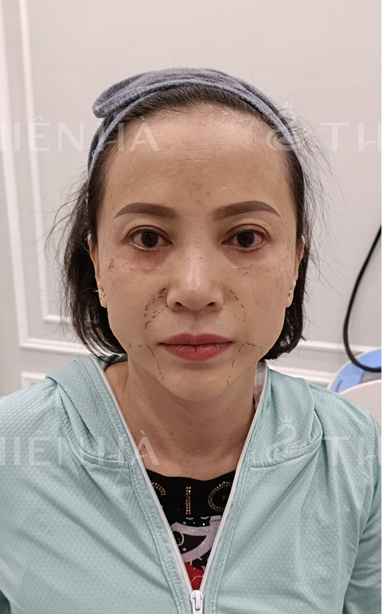 Trẻ hóa – 3 buổi – Khuôn mặt hài hòa gọn gàng - trước