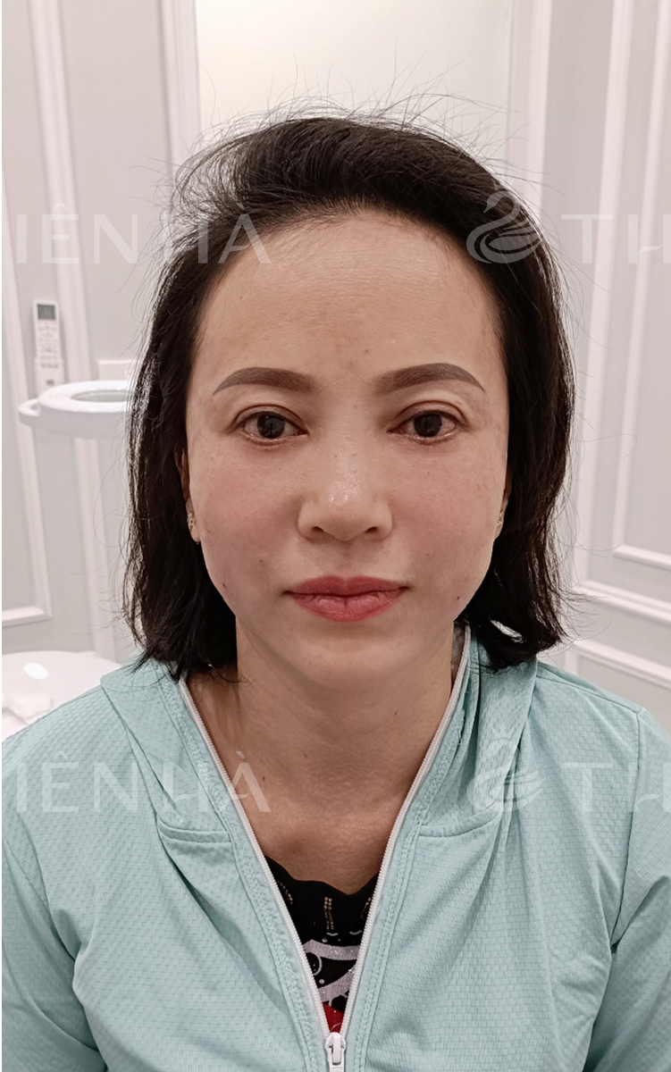 Trẻ hóa – 3 buổi – Khuôn mặt hài hòa gọn gàng - sau