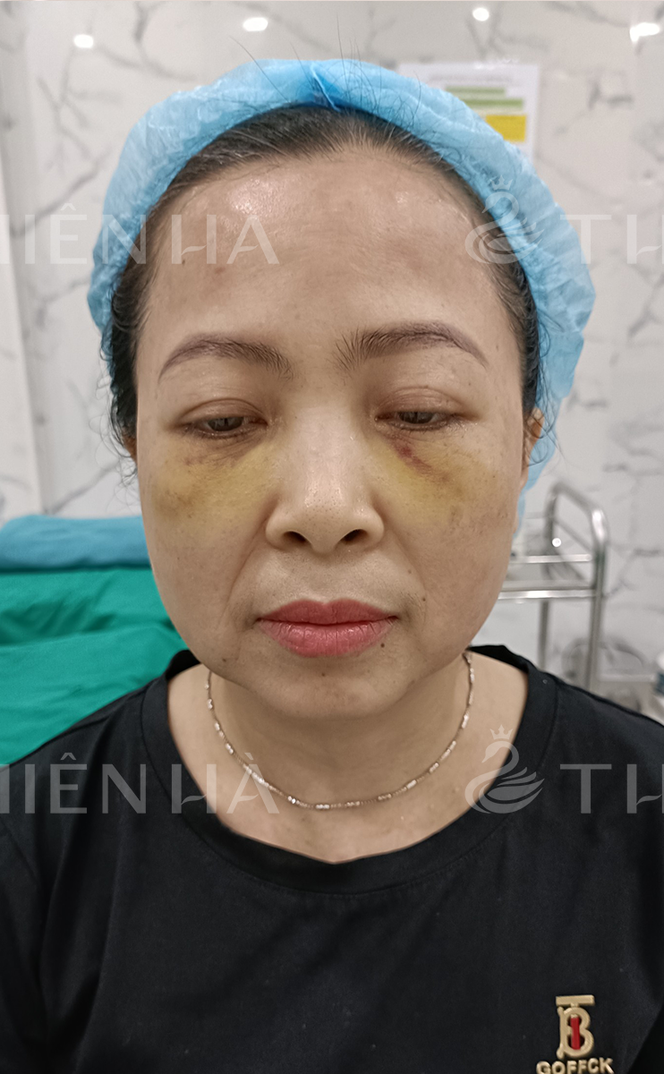 Trẻ hóa – 8 buổi – Nếp nhăn giảm rõ rệt - trước