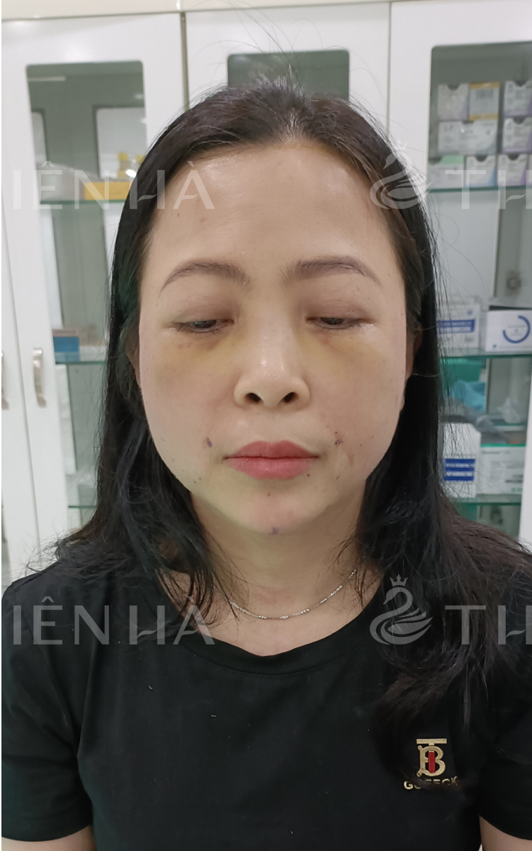 Trẻ hóa – 8 buổi – Nếp nhăn giảm rõ rệt - sau