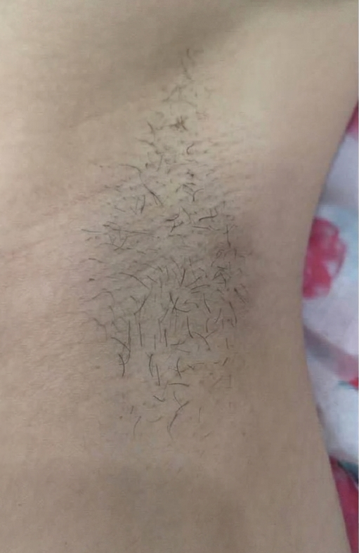 Triệt lông nách – 8 buổi – Vùng cánh sáng màu rõ rệt - trước