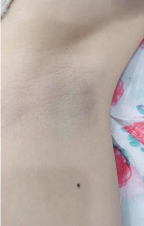 Triệt lông nách – 8 buổi – Vùng cánh sáng màu rõ rệt - sau