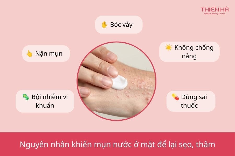 Mụn nước ở mặt có để lại sẹo hoặc thâm không?