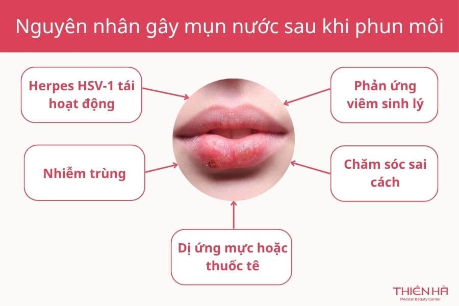 Phun môi bị mụn nước phải làm sao? Hướng dẫn xử lý an toàn 2 Nguyên nhân gây mụn nước sau phun môi