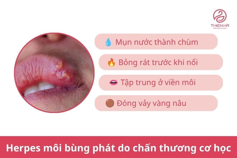 Phun môi bị mụn nước phải làm sao? Hướng dẫn xử lý an toàn 3 Cách nhận biết Herpes môi bùng phát do chấn thương cơ học