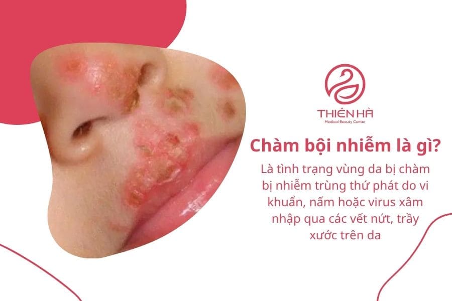 Chàm bội nhiễm là gì?