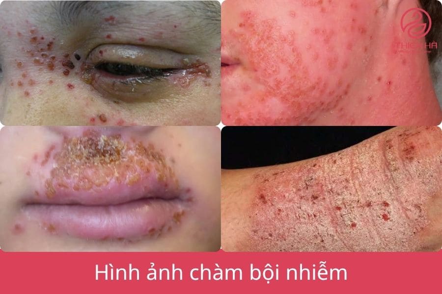 Hình ảnh thực tế chàm bội nhiễm