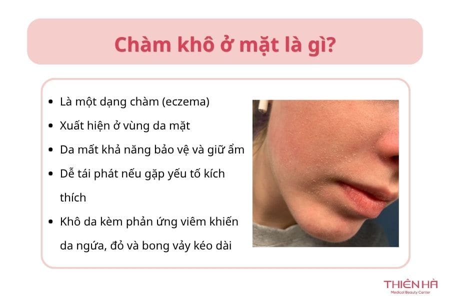 Chàm khô ở mặt là gì?