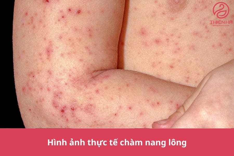 Hình ảnh thực tế chàm nang lông