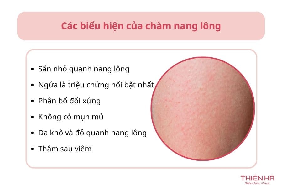 Cách nhận biết các biểu hiện của chàm nang lông trên cơ thể bạn