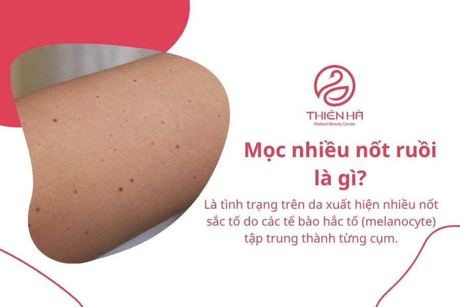 Mọc nhiều nốt ruồi: Có nguy hiểm không và nên xử lý thế nào? 1 Mọc nhiều nốt ruồi là gì?