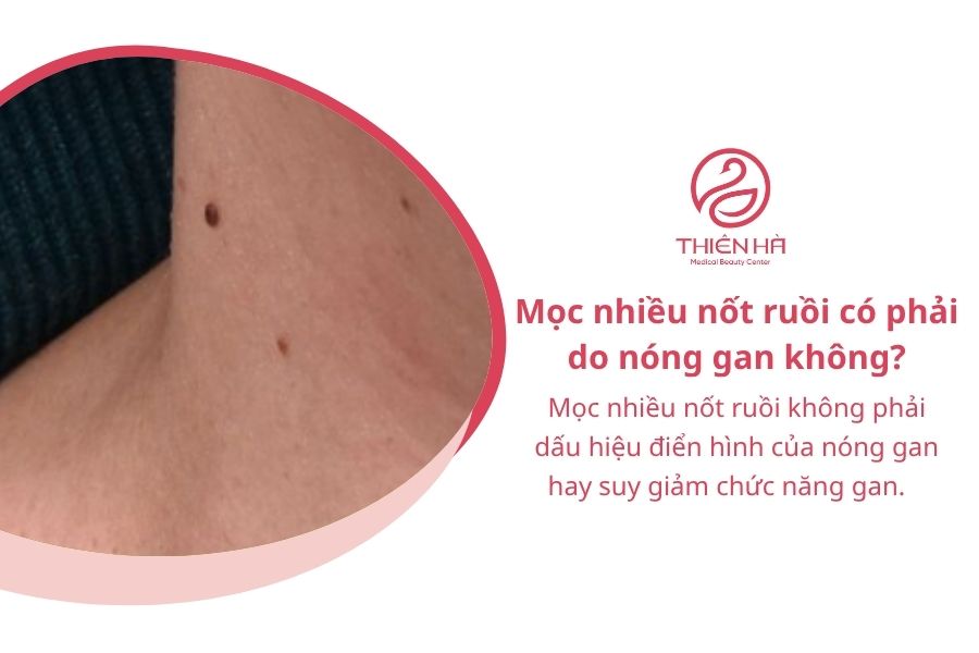 Mọc nhiều nốt ruồi: Có nguy hiểm không và nên xử lý thế nào? 7 Câu hỏi thường gặp về mọc nhiều nốt ruồi