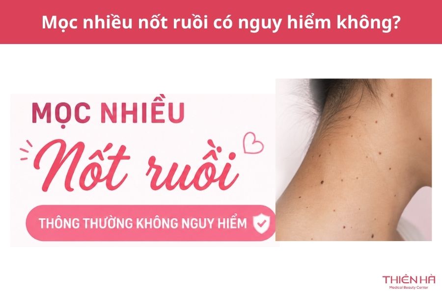 Mọc nhiều nốt ruồi: Có nguy hiểm không và nên xử lý thế nào? 3 Mọc nhiều nốt ruồi có nguy hiểm không?