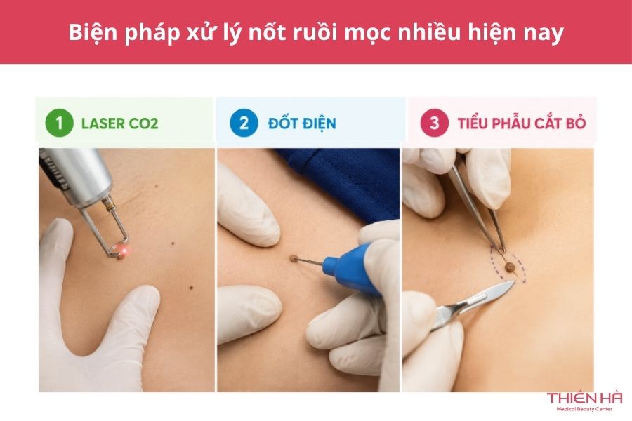 Mọc nhiều nốt ruồi: Có nguy hiểm không và nên xử lý thế nào? 5 Biện pháp xử lý nốt ruồi mọc nhiều hiện nay