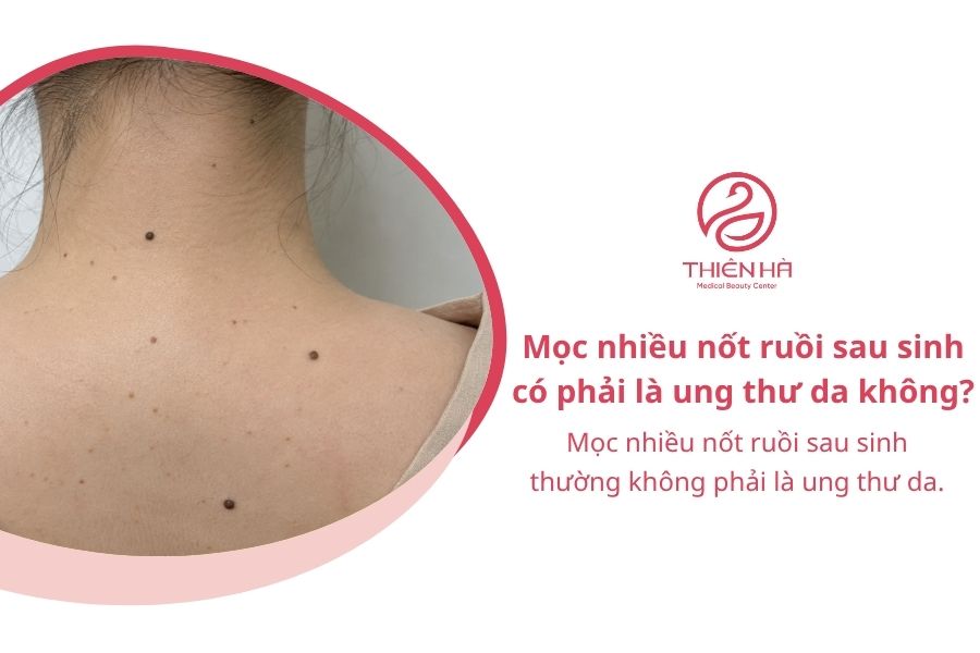 Mọc nhiều nốt ruồi sau sinh có phải là ung thư da không?