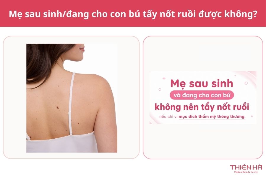 Mẹ sau sinh/đang cho con bú có tẩy nốt ruồi được không?