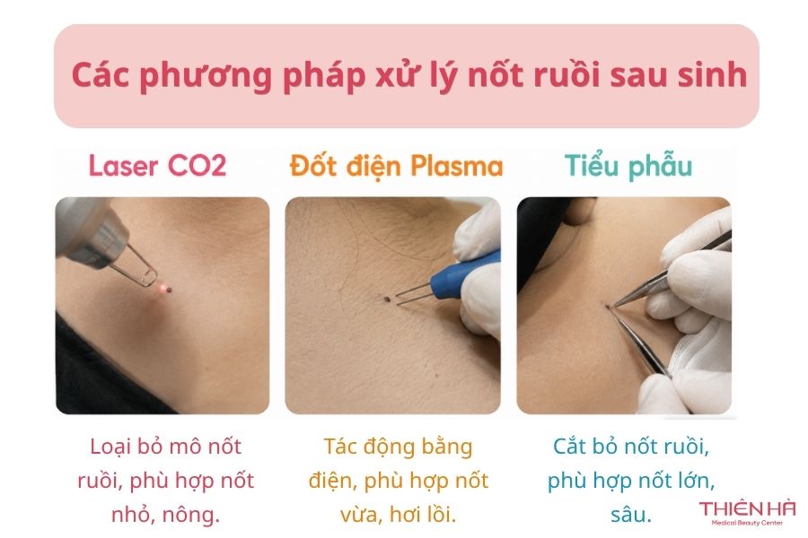 Các phương pháp xử lý nốt sau sinh ruồi hiện nay
