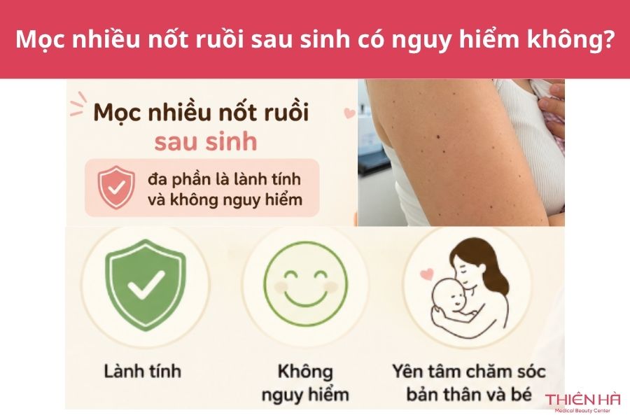 Mọc nhiều nốt ruồi sau sinh có nguy hiểm không?