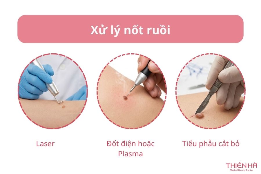 Xử lý nốt ruồi