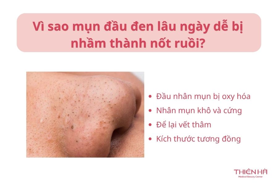 Vì sao mụn đầu đen lâu ngày dễ bị nhầm thành nốt ruồi?
