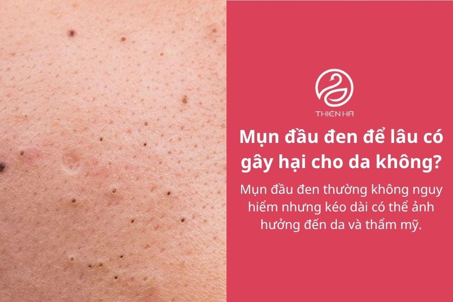 Mụn đầu đen để lâu có gây hại cho da không?