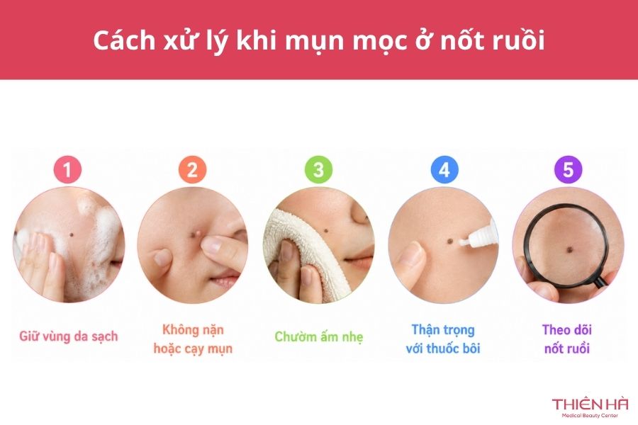 Mụn mọc ở nốt ruồi có nguy hiểm không? Nguyên nhân và cách xử lý 5 Cách xử lý khi mụn mọc ở nốt ruồi