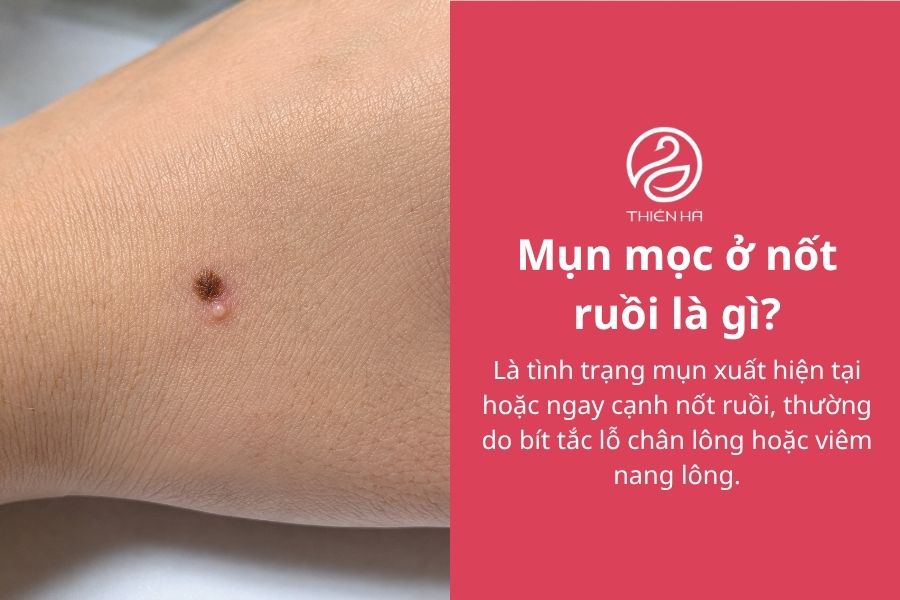 Mụn mọc ở nốt ruồi có nguy hiểm không? Nguyên nhân và cách xử lý 1 Mụn mọc ở nốt ruồi là gì?