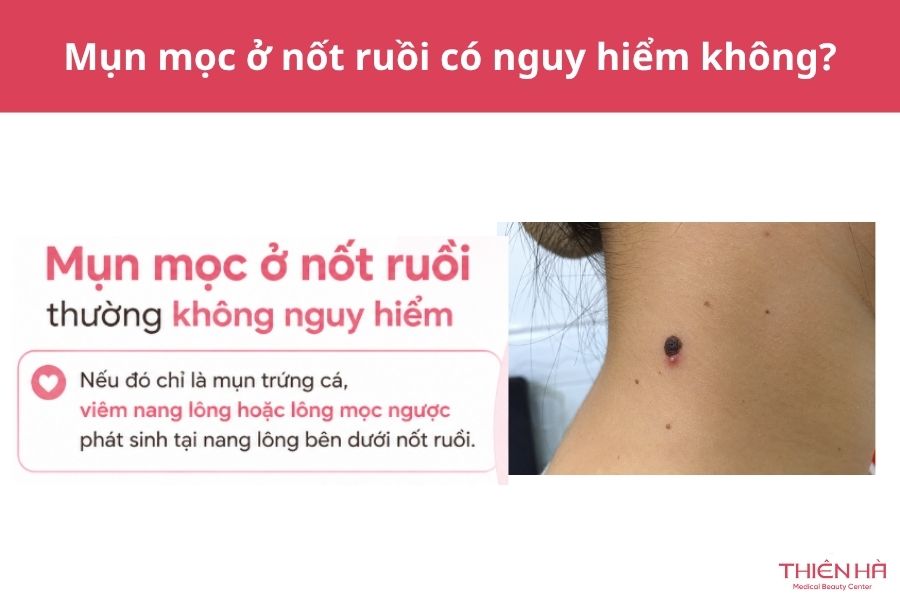 Mụn mọc ở nốt ruồi có nguy hiểm không? Nguyên nhân và cách xử lý 3 Mụn mọc ở nốt ruồi có nguy hiểm không?