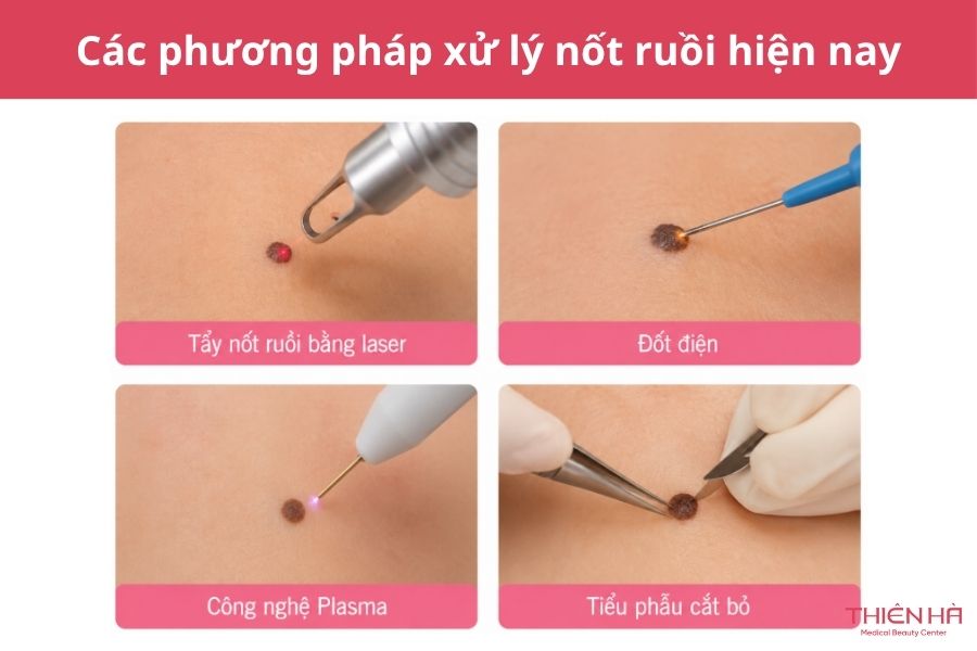 Các phương pháp xử lý nốt ruồi hiện nay