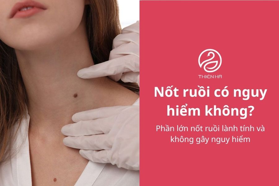 Nốt ruồi có nguy hiểm không?