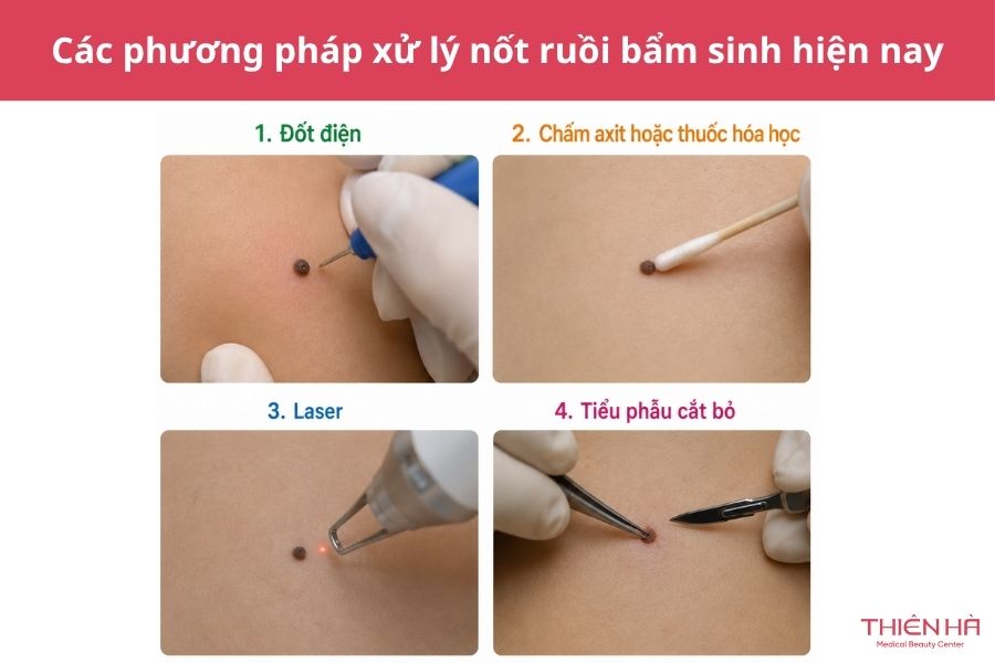 Các phương pháp xử lý nốt ruồi bẩm sinh hiện nay