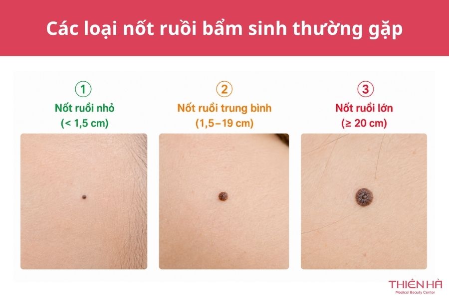 Các loại nốt ruồi bẩm sinh thường gặp