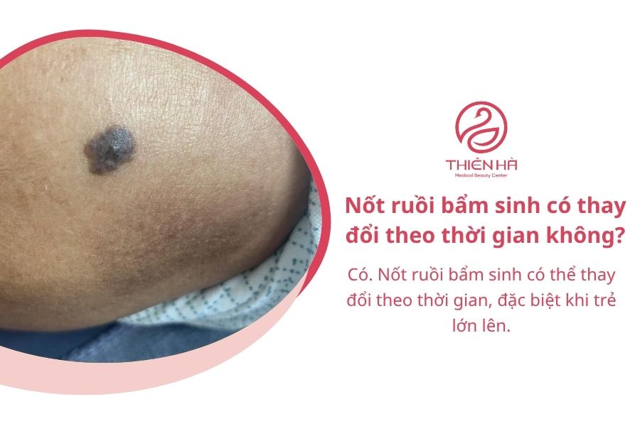 Nốt ruồi bẩm sinh có thay đổi theo thời gian không?